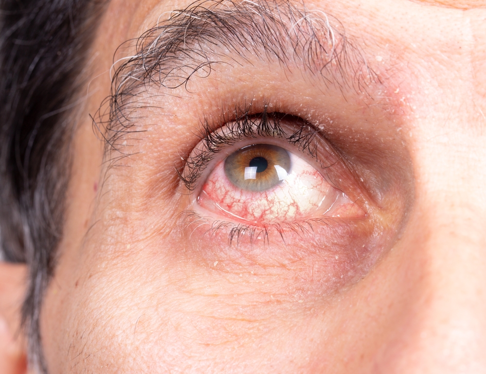 Man looking up, showing red and inflamed eye, a symptom of uveitis.